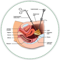 لاپاراسکوپی درمان ناباروری